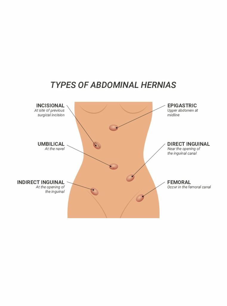 Femoral hernia Information